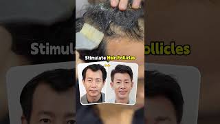 8 Months Miracle with Jonsson Protein Hair Growth Treatment [upl. by Ches]