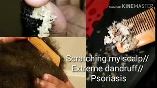 Scratching my scalp Extreme dandruff psoriasis [upl. by Dempster]