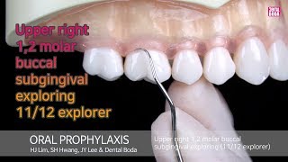 Upper right 12 molar buccal subgingival exploring 1112 explorer [upl. by Haras]