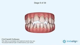 Invisalign Clincheck [upl. by Felise]