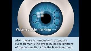 How LASIK Eye Surgery or Laser Eye Surgery Works [upl. by Grenville841]