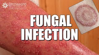 Suffering from Fungal Infection Ringworms WATCH THIS [upl. by Krissy772]