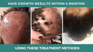 Mesotherapy for Hair Loss Before amp After Results  Platelet Rich Plasma for Hair Loss [upl. by Searby]