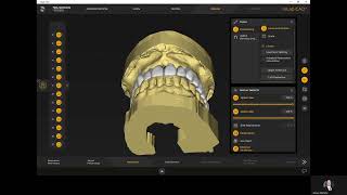 French inLab 22 Complete over Natural Dentures [upl. by Hserus]