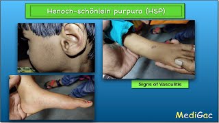 HenochSchonlein PurpuraHSP  Clinical features  Pathophysiology  Diagnosis and Treatment [upl. by Tizes]