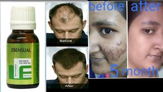 Modicare tea tree oil benefits How to use Tea tree oil [upl. by Lleret628]