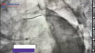 Left Main Ostial IVUS guided Angioplasty by Dr Rhishikesh Umalkar [upl. by Hebel829]