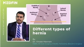 Types of Hernia [upl. by Miahc]