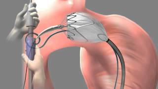 Thoracic Aortic Graft  Medical Animation by Watermark [upl. by Rowe]