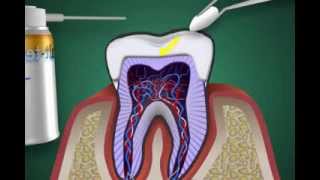was ist eine Zahnnerventzündung  Pulpitis [upl. by Loreen540]