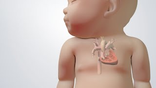 Blue Baby Heart Defect Tetralogy of Fallot Treatments [upl. by Acinelav]