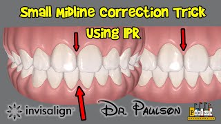 Midline Trick using IPR and Invisalign  Paulson Orthodontics [upl. by Mufi989]