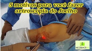 5 motivos para você fazer artroscopia do joelho [upl. by Norine]