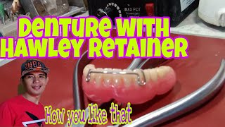 Denture with Retainer Installing Hawley Retainer on Lower Complete Dentures Pustiso with retainer [upl. by Celinka]