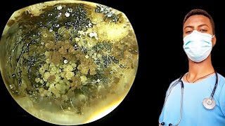 🔴cleaning of fungi affected ear full of it earearwax earwaxremovalearwaxcleaningasmr [upl. by Bound]