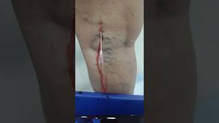 Venesection for Varicose Vein by Dr Hussain at Hussaingreekcliniccom [upl. by Glaab]