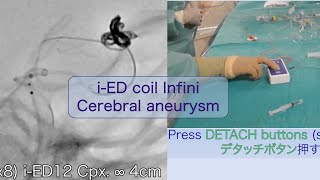 iED Coil Infini for cerebral aneurysm [upl. by Laurent875]