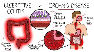 Inflammatory Bowel Disease  Ulcerative Colitis v Crohns Disease With Histology amp Manifestations [upl. by Libys900]