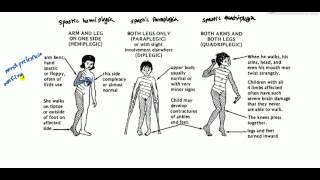 Cerebral Palsy for USMLE Step 2 [upl. by Gable]