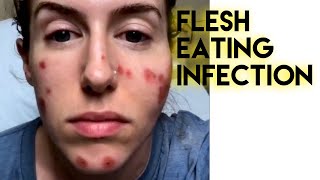 FleshEating Bacterial Infection in my face [upl. by Ruy]