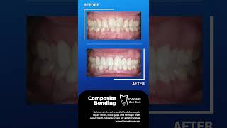 Transform Your Smile with Composite Bonding  Fast and Effective Tooth Repair compositebonding [upl. by Uttasta]