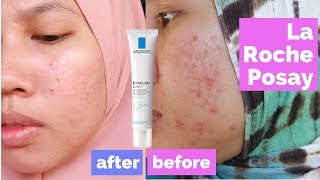 Review La Roche Posay Effaclar Duo Plus Ampuh Menghilangkan Jerawat [upl. by Aicilla]