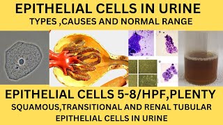 EPITHELIAL CELLS IN URINE ANALYSISTYPES NORMAL RANGE CAUSESRISK OF EPTHELIAL CELLS IN URINE [upl. by Rustie]