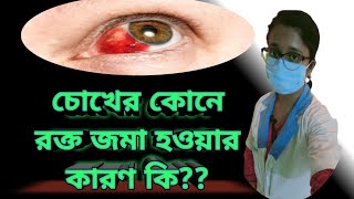 What is subconjunctival hemorrhage Causes amp Treatment in Bengali  in details [upl. by Navonod890]