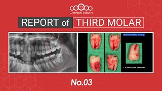 EMULTISUB Extraction of distoangular Lt Mn third molar  Dr Cho Yongseok [upl. by Yednarb377]