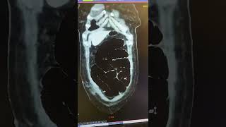 Appendix operation after that small bowel obstruction ctscan mri viralvideo shorts medical [upl. by Fusuy911]