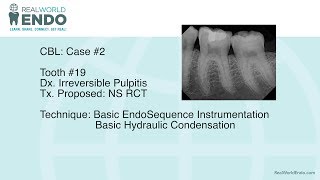 CBL 2 Basic Molar Root Canal Therapy 19 by RealWorldEndo [upl. by Cleodal]