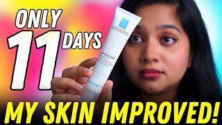 😲 Improve Your Skin in Just 11 Days My Before amp After Results with La RochePosay Effaclar Duo [upl. by Arracahs]