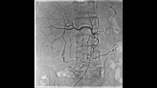 Medical Angiography  Abdominal RSMDSA Precession Mode [upl. by Yrailih]