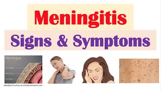 Meningitis Signs and Symptoms amp Why They Occur [upl. by Jat257]