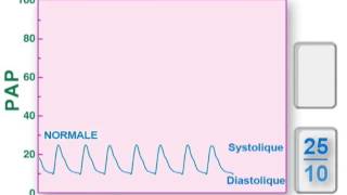 pression artérielle pulmonaire [upl. by Aveline989]