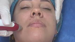 Tratamiento facial con Dermapen [upl. by Harlow823]