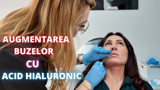 Volumizarea 💋 Buzelor cu Acid Hialuronic  DermaBeauty Clinique [upl. by Delanos]