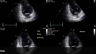 Abnormal Dobutamine stress echocardiogram [upl. by Jennilee]