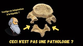 Le Spondylolisthésis estil une pathologie [upl. by Zipah]