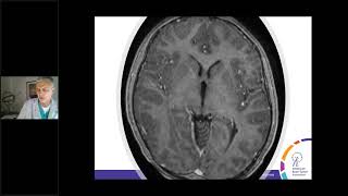 Medulloblastoma  Malignant Brain Tumor in Children amp Adults [upl. by Ninnette345]