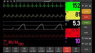 Anaphylaxis [upl. by Grantland488]