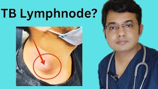 TB Lymphnode Symptoms Diagnosis amp Treatment Tuberculous lymphadeniyis [upl. by Bloomer]