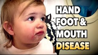 HAND FOOT amp MOUTH DISEASE Live Diagnosis  Dr Paul [upl. by Eadrahc]