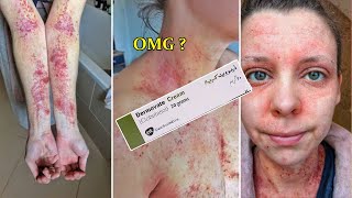 Dermovate Cream Review in English  Skin Lightening Eczema Fungus amp Pigmentation Solutions [upl. by Ambrosia]