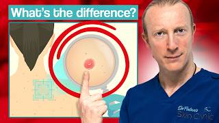 Innocent Skin Lesion or Skin Cancer What should you do [upl. by Irret]