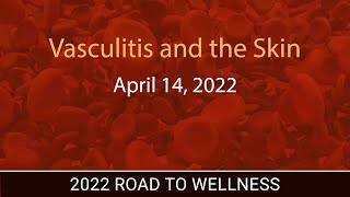 Vasculitis and the Skin [upl. by Publus192]