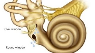 Perilymphatic fistula [upl. by Northington]