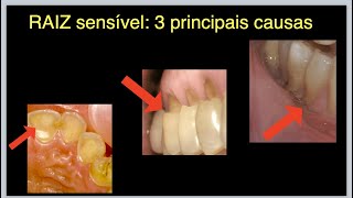 RAIZ DO DENTE SENSÍVEL CONHEÇA AS 3 CAUSAS PRINCIPAIS [upl. by Shirk]