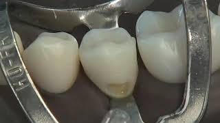 Class V Composite Preparation amp Restoration  Operative Dentistry [upl. by Doner139]