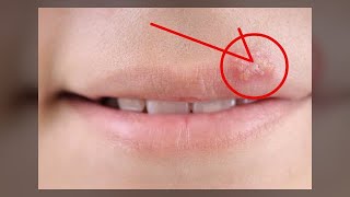 5 hausgemachte Heilmittel um Lippenherpes zu behandeln  Tipps [upl. by Kelbee603]